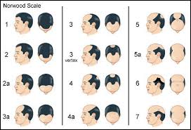 Norwood Scale Baldness Chart Hair Loss Medication Hair
