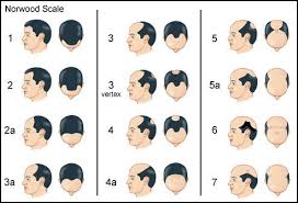 norwood scale baldness chart hair loss medication hair