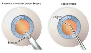 Image result for Cataract Extraction