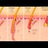 Exfoliate another effective thing you can do to prevent ingrown hairs is to exfoliate. 3