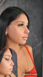 Dr. Juan Manuel Caso Demársico(@dr.casolipsandrhino) • Instagram写真と動画