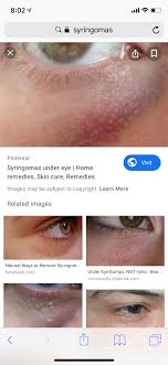 We said that face bumps will often vary in symptoms depending on what the underlying cause. Under Eye Bumps Not Milia Beauty Insider Community