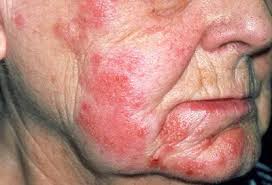 Image result for Varicella zoster on human skin