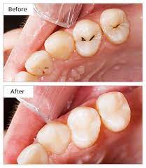 Do teeth fillings hurt metal. Tooth Fillings Brooklyn Ny Dental Porcelain Fillings