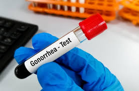 Gonorrhea test Syphilis Gonorrhea disease