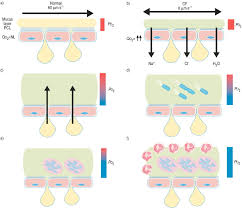 Cystic fibrosis (cf) is a multisystem hereditary disease that mainly affects the lungs and digestive system, causing progressive disability and for some, early death. New Concepts Of The Pathogenesis Of Cystic Fibrosis Lung Disease European Respiratory Society