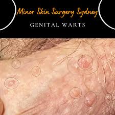 Image result for genital warts