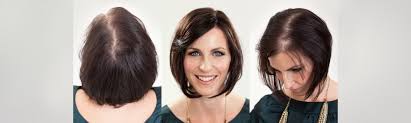 That might be eczema, psoriasis, or a condition called frontal fibrosing alopecia, which typically causes scarring and hair loss — sometimes permanent — at the front of the scalp above the forehead. Hair Loss In Women Causes Treatment Transitions Hair