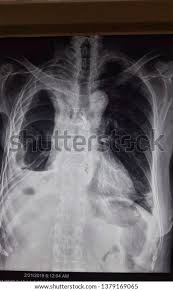 Pleural effusion develops when more fluid enters the pleural space than is removed. Loculated Pleural Effusion Chest X Ray Tuberculous Pleural Effusion Shaw 2019 Respirology Wiley Online Library It Was Embolised With Coil And Onyx