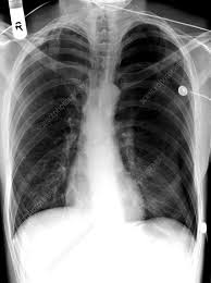 Image result for Pneumothorax