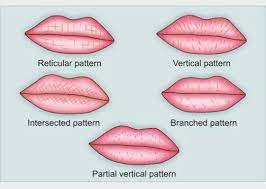 Types Of Inner Lip Patterns Types Of Lips Shape Lip Types Lips