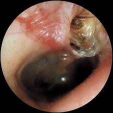 Image result for Mastoiditis