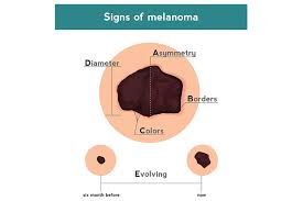Men are more likely to die of melanoma than women. Abcde Of Skin Cancer Cone Health
