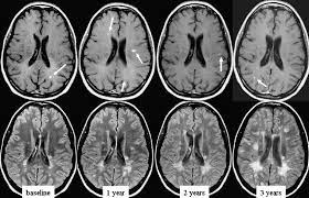 But abnormal mri results do not always mean that you have ms. Relapsing Form Of Multiple Sclerosis Serial Contrast Enhanced T1 W Download Scientific Diagram