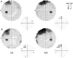 Image result for Visual Field Deficit