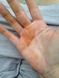 There are many carotenoids, and most are not orange. Weird Hand Staining November 2014 Babies Forums What To Expect Page 3