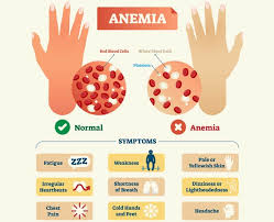 Anemia is a condition in which hemoglobin concentration, or the number of red blood cells, is below the defined level. What Causes Iron Deficiency How To Prevent Anemia