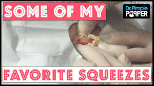 Pimple popper' sets out to help patients with serious dermatological problems. In Memory Of Some Of My Favorite Squeezes Dr Pimple Popper Youtube