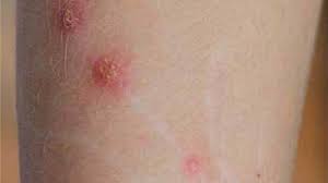 Learn cat scratch fever faster with songsterr plus plan! Cat Scratch Fever Causes Symptoms And Diagnosis