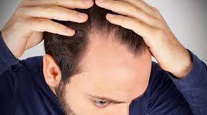 ➨ jetzt über günstige optionen informieren! Kampf Dem Haarausfall Transplantation Auf Dem Kopf Rbb