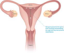 How Copper Iud Works Paragard Iud