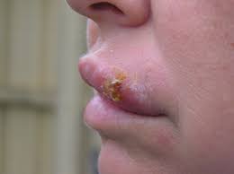 How The Cold Sore Virus Takes The Killer Out Of Our Immune System Scimex