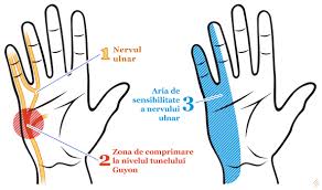 Urmeaza apoi tratamentul dat de catre medicul specialist. Paralizia Nervului Ulnar Neuropatia Ulnara