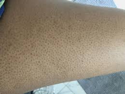Image result for Keratosis pilaris