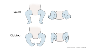 Image result for Clubfoot