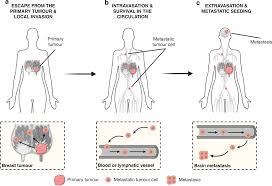 How do you know if cancer has spread to your bones. The Lingering Mysteries Of Metastatic Recurrence In Breast Cancer British Journal Of Cancer