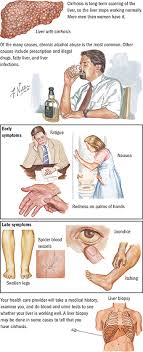 Let us know that what are the main symptoms of liver cancer. Liver Cirrhosis Spectrum Health