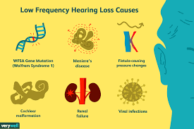 definition and causes of low frequency hearing loss