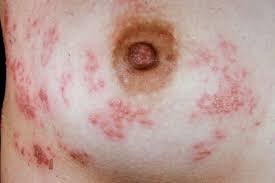Image result for heat rash under breasts