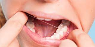 Maybe you would like to learn more about one of these? How To Care For Yourself After Wisdom Teeth Removal Implants Oral Surgery Of Chattanooga