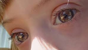 Epicanthic fold (/ɛpɪˌkænθɪkˈfoʊld/), epicanthal fold, epicanthus, or simply eye fold are names for a skin fold of the upper eyelid, covering the inner corner (medial canthus) of the eye. Down Syndrome Physical Examination Wikidoc