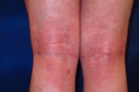 Image result for Intertrigo under breasts