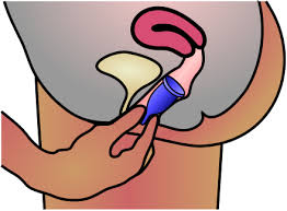 After a user inserts the cup, it remains in place with suction. Menstrual Cup Wikiwand