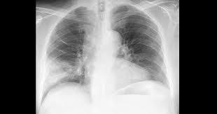 Jangkitan paru paru tanda penyakit pneumonia yang harus diawasi theasianparent malaysia. Jangkitan Paru Paru Punca Simptom Dan Rawatan The Diagnosa