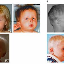 There are fewer than 200 people with the. Pdf Hallermann Streiff Syndrome No Evidence For A Link To Laminopathies