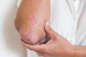 Severe Eczema Treatments For Adults And Children