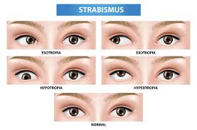 Eye Exercises For Blurred Vision