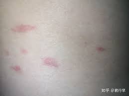 丘疹性荨麻疹像蚊子叮的，全身长，剧烈瘙痒，一个星期后会变黑- 知乎