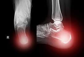 Since a bone spur will not go away on its own, options to relieve bothersome preventing bone spurs on the foot. Bone Spur Causes Treatment Pictures Surgery Symptoms