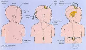 Ventriculoperitoneal Shunts Pediatrics Clerkship The University Of Chicago Pediatric Nursing Pediatrics Child Life Specialist