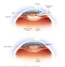 cataracts diagnosis and treatment mayo clinic