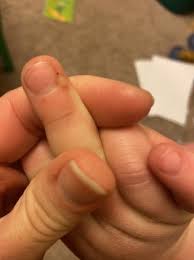 It's been about six hundred years after all. Is This A Wart Babycenter