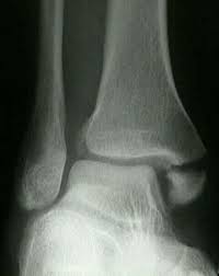 The best xray camera application for android! Ankle X Rays