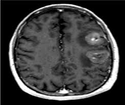 There are other conditions that can mimic pc, such as pseudomyxoma peritonei, peritoneal lymphomatosis, peritoneal malignant mesothelioma, leiomyomatosis peritonealis disseminata, and tuberculous peritonitis. Metastic Mesothelioma To The Brain A Potential Differential Diagnosic Challenge