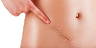 Haz tu selección entre imágenes premium sobre hernia inguinal de la más alta calidad. Iocir Com Hernia Incisional Sintomas Y Tratamiento Cirujanos En Huelva