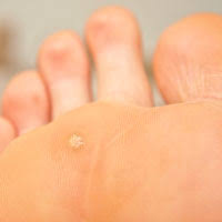 Plantar warts are skin growths that appear on the soles of the feet. Types Of Warts Wart Treatments Knoxville Tennessee
